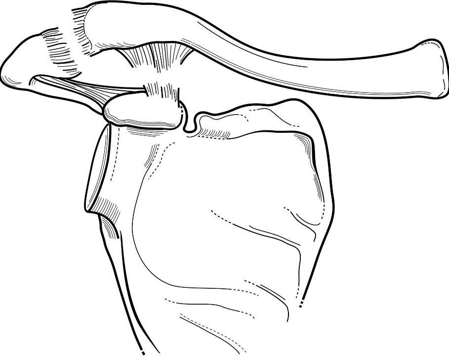 Figure 6 for case Grade 3 AC separation ( RID1895 )